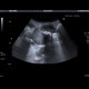 Emphysematous cholecystitis, pericholecystitic abscess: US - Ultrasound